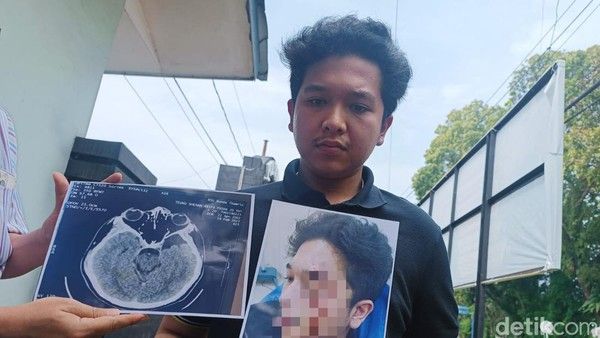 Kasat Narkoba DS Bantah Anaknya MZE Aniaya Mahasiswa UISU