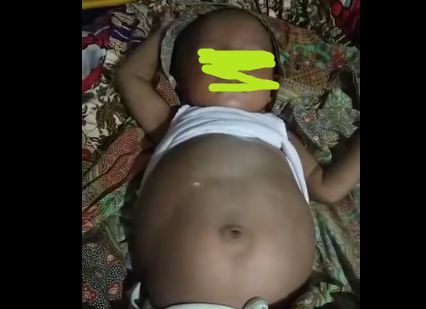 Heboh Bayi 5 Bulan 'Hamil', Setelah di USG Ternyata Berisi Janin Hidup
