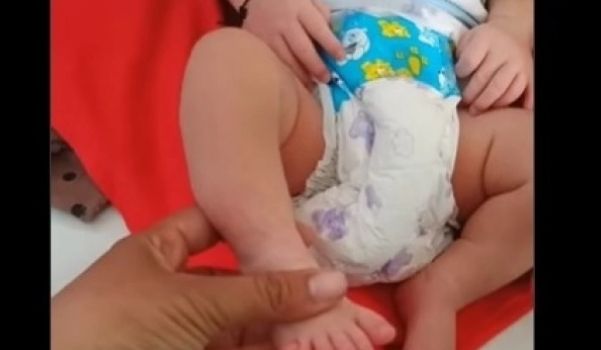 Viral Bayi di Sampang Lahir dengan Tangan dan Kaki Punya 6 Jari, Total 24 Jari
